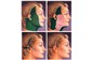Ritidoplastia - lifting facial – plástica de face