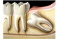 Exodontia (Extração Dentária) no Montese 