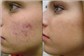 Tratamento de Acne