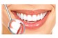 Clareamento Dentário 