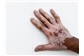 Tratamento de Vitiligo